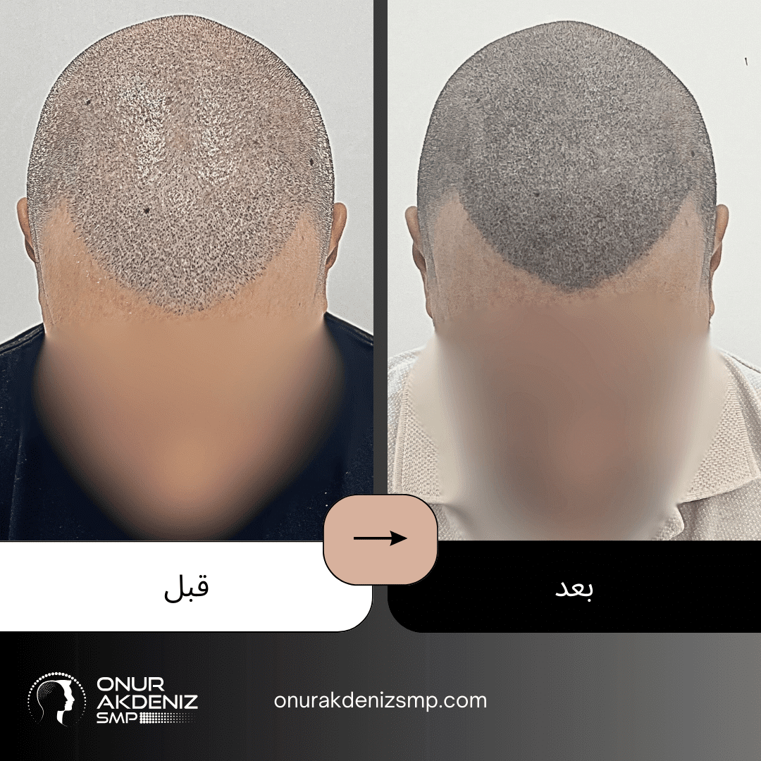 تصبغ فروة الرأس المجهري قبل وبعد للحصول على مظهر الشعر المحلوق مع أونور أكدينيز 23