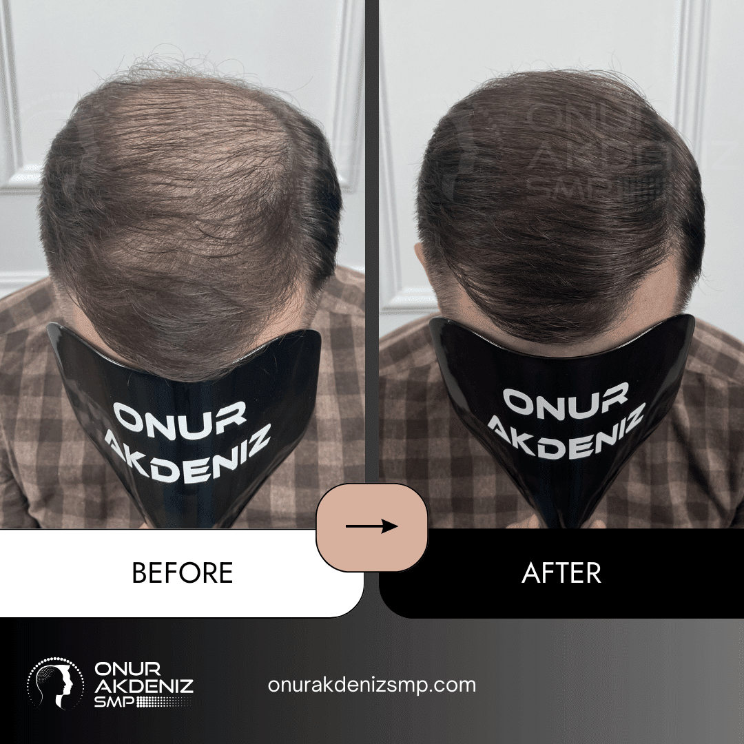 Onur Akdeniz SMP 107 Before and After Hair Densification for Men Onur Akdeniz SMP Istanbul Turkey 56