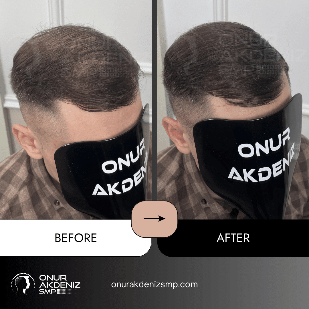 Onur Akdeniz SMP 108 Before and After Hair Densification for Men Onur Akdeniz SMP Istanbul Turkey 57