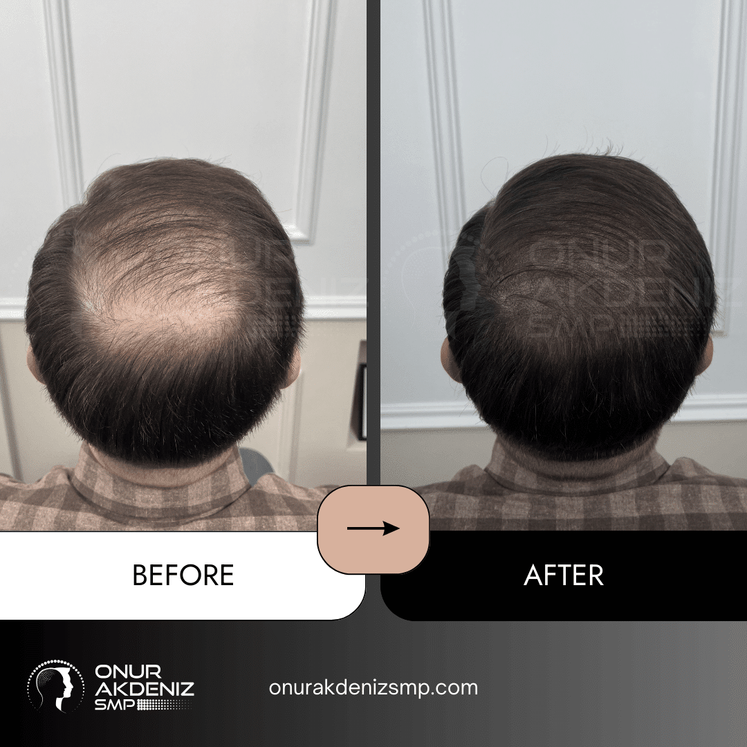 Onur Akdeniz SMP 112 Before and After Hair Densification for Men Onur Akdeniz SMP Istanbul Turkey 61