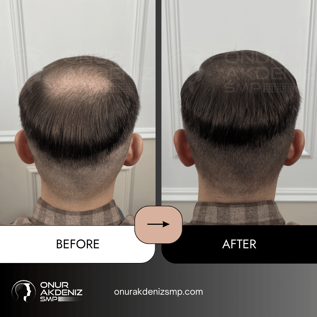 Onur Akdeniz SMP 113 Before and After Hair Densification for Men Onur Akdeniz SMP Istanbul Turkey 62