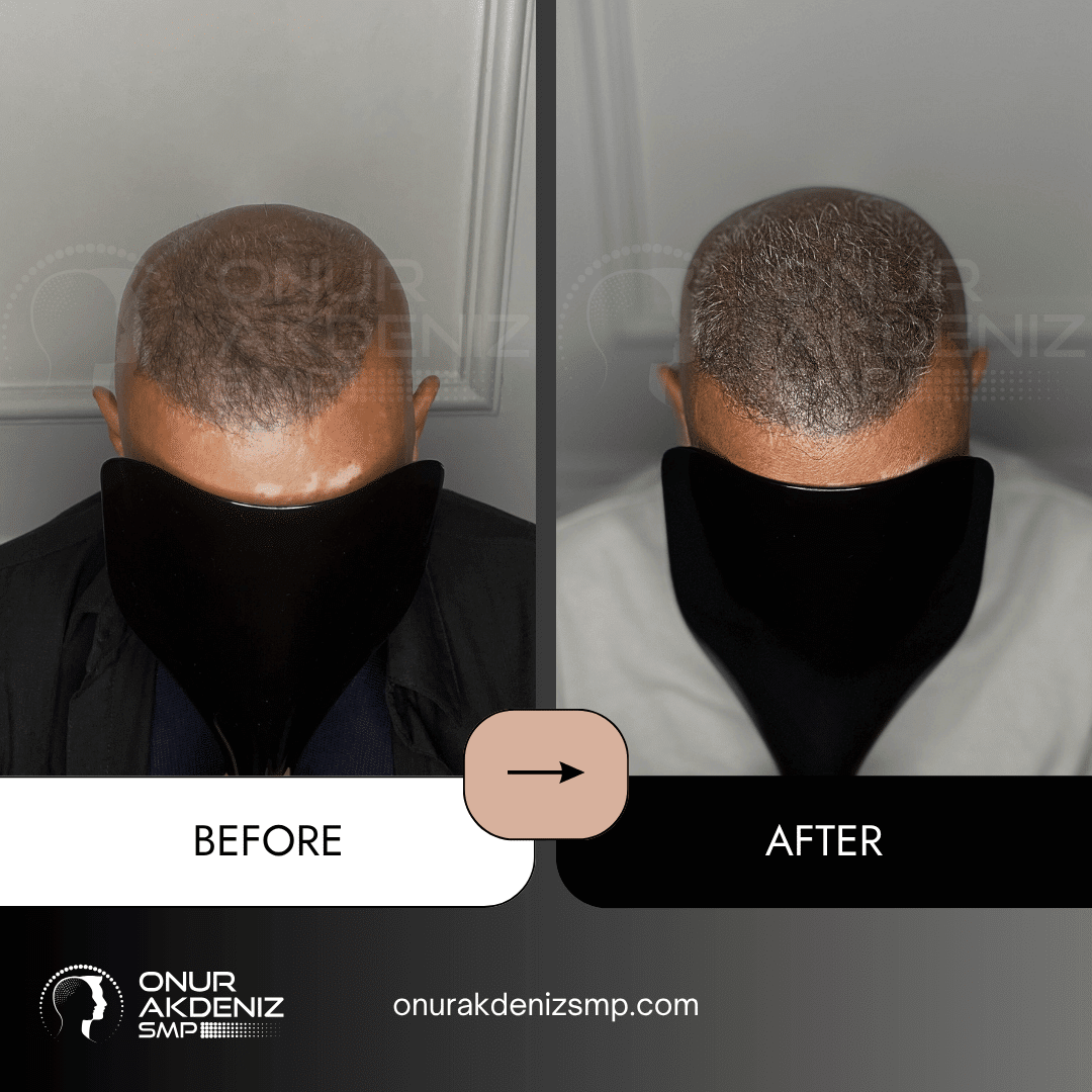Onur Akdeniz SMP 169 Before and After Hair Densification for Men Onur Akdeniz SMP Istanbul Turkey 63