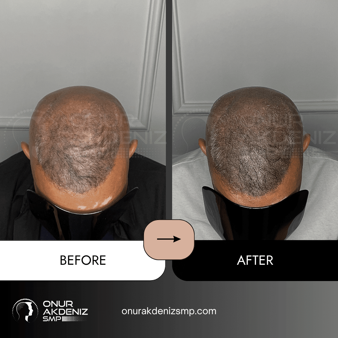 Onur Akdeniz SMP 170 Before and After Hair Densification for Men Onur Akdeniz SMP Istanbul Turkey 64