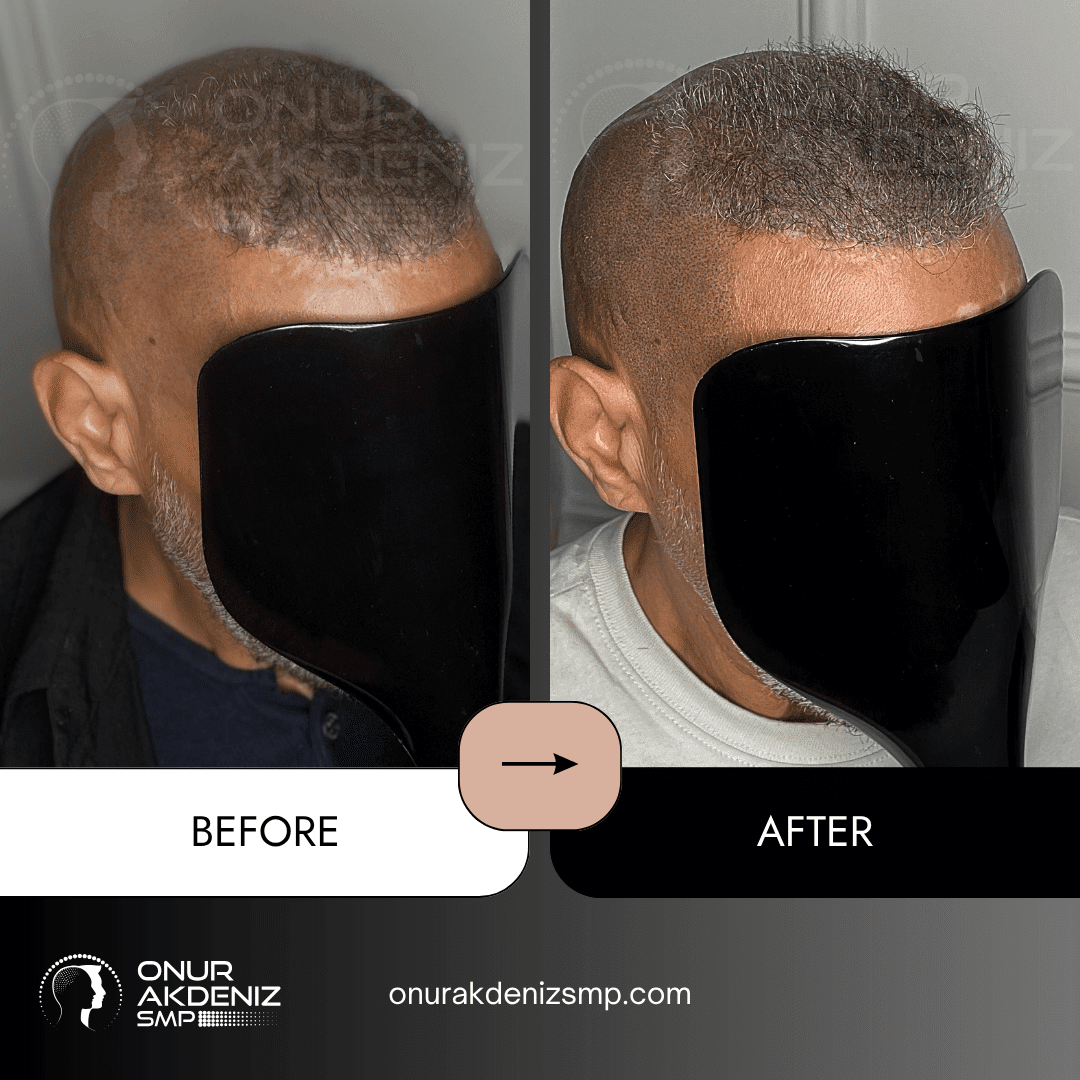 Onur Akdeniz SMP 171 Before and After Hair Densification for Men Onur Akdeniz SMP Istanbul Turkey 65