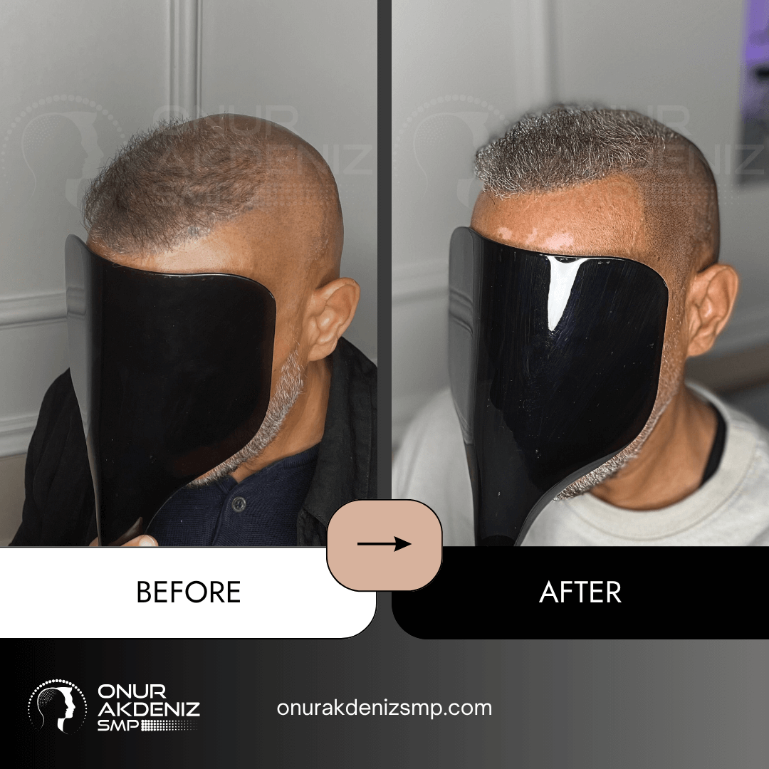 Onur Akdeniz SMP 172 Before and After Hair Densification for Men Onur Akdeniz SMP Istanbul Turkey 66