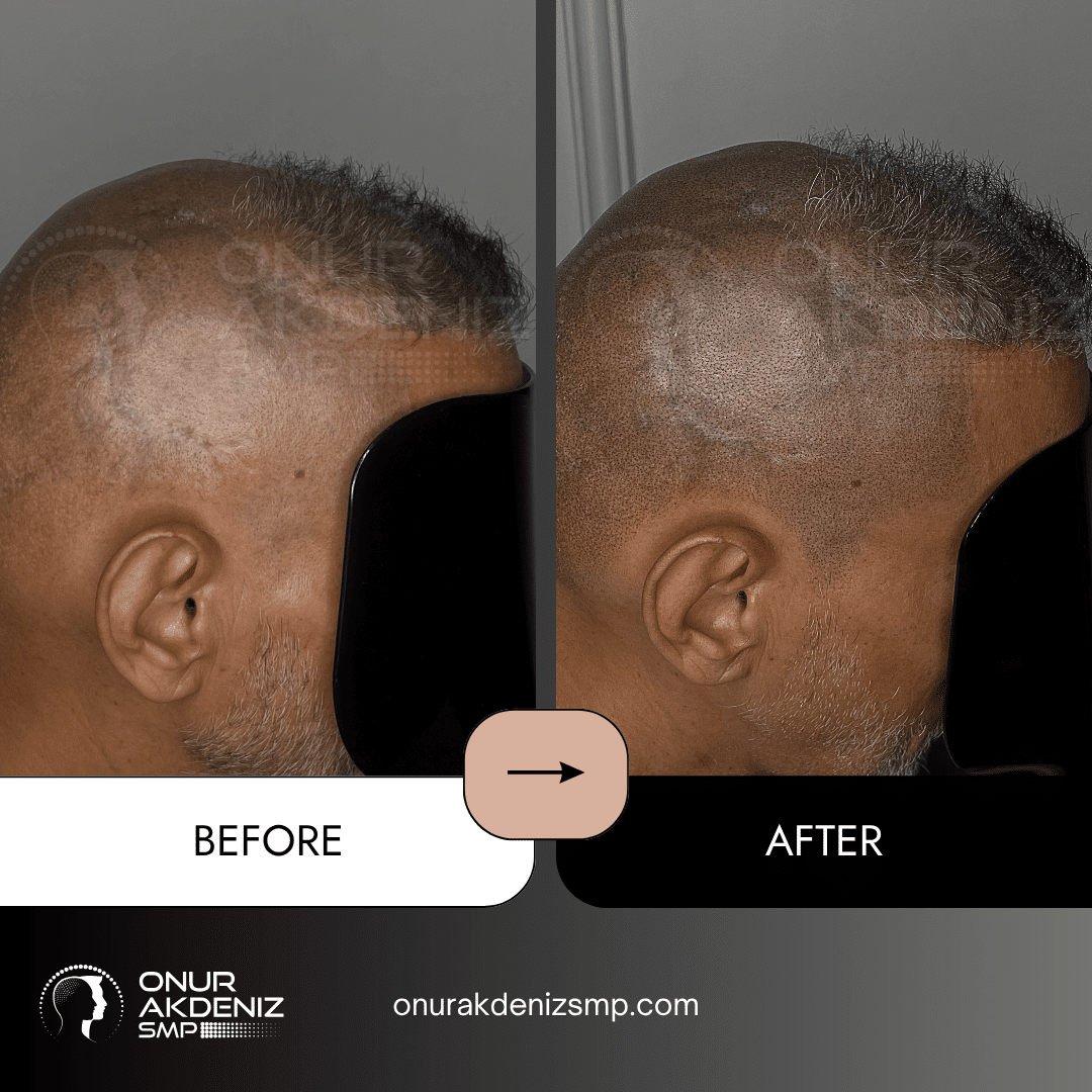Onur Akdeniz SMP 173 Before and After Hair Densification for Men Onur Akdeniz SMP Istanbul Turkey 67