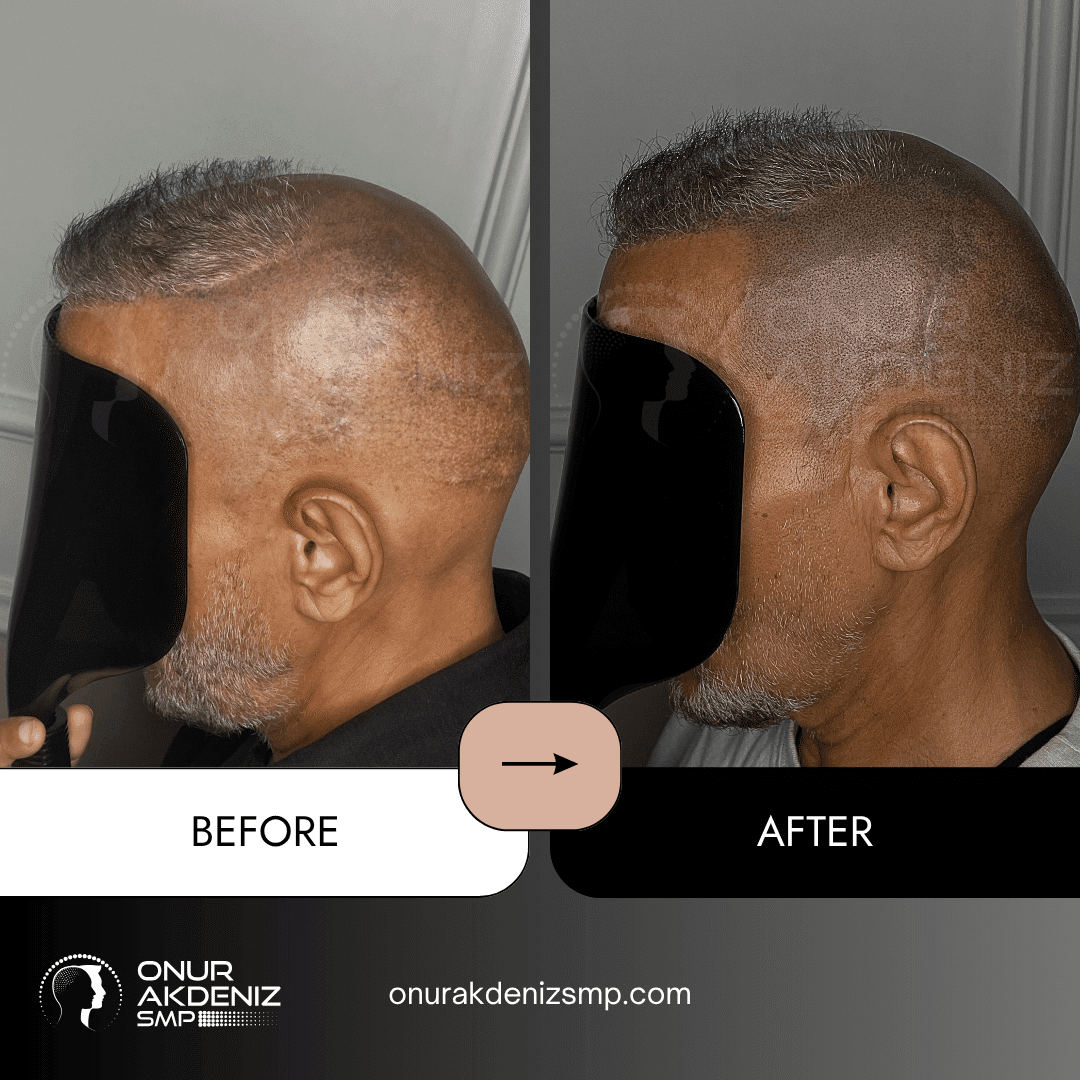 Onur Akdeniz SMP 174 Before and After Hair Densification for Men Onur Akdeniz SMP Istanbul Turkey 68