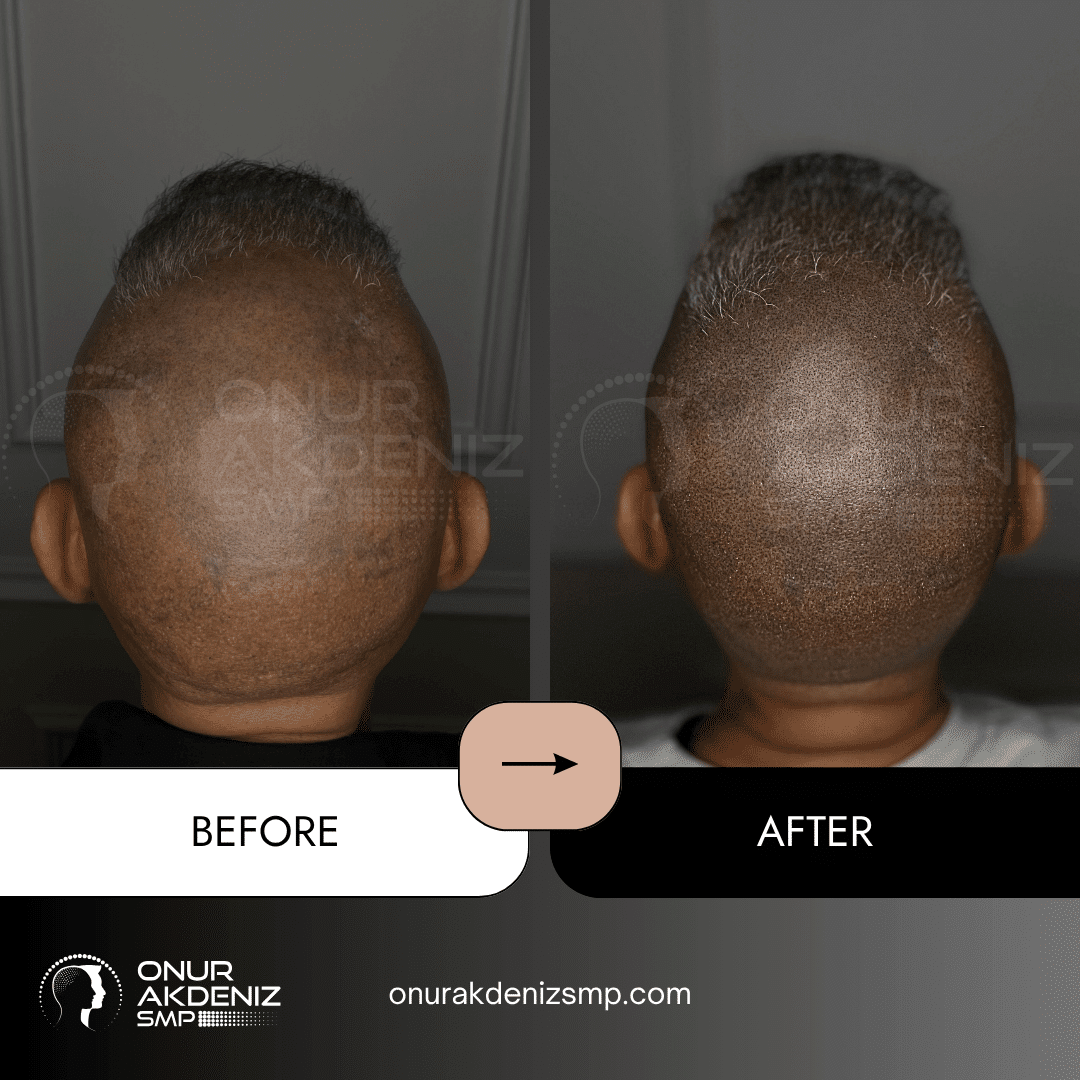 Onur Akdeniz SMP 175 Before and After Hair Densification for Men Onur Akdeniz SMP Istanbul Turkey 69