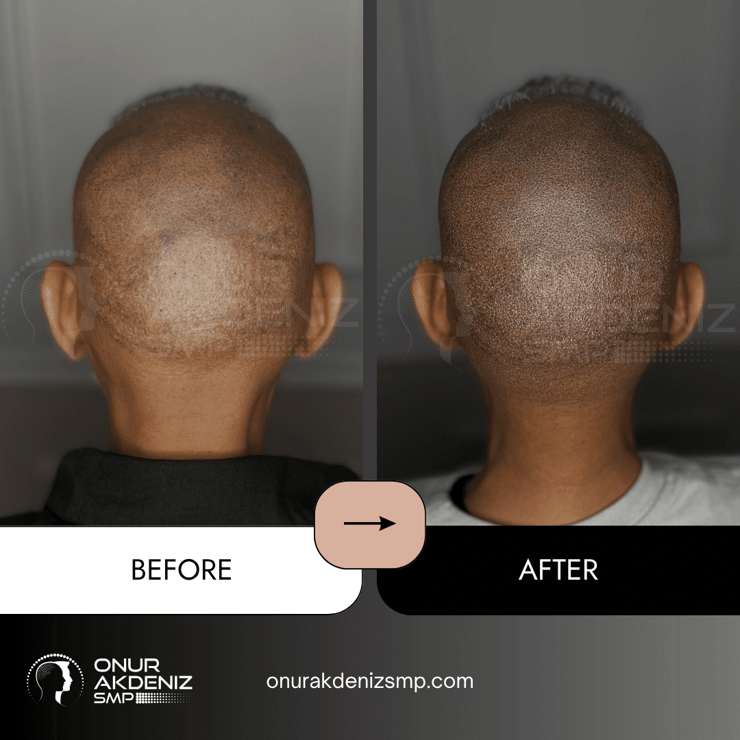Onur Akdeniz SMP 176 Before and After Hair Densification for Men Onur Akdeniz SMP Istanbul Turkey 70