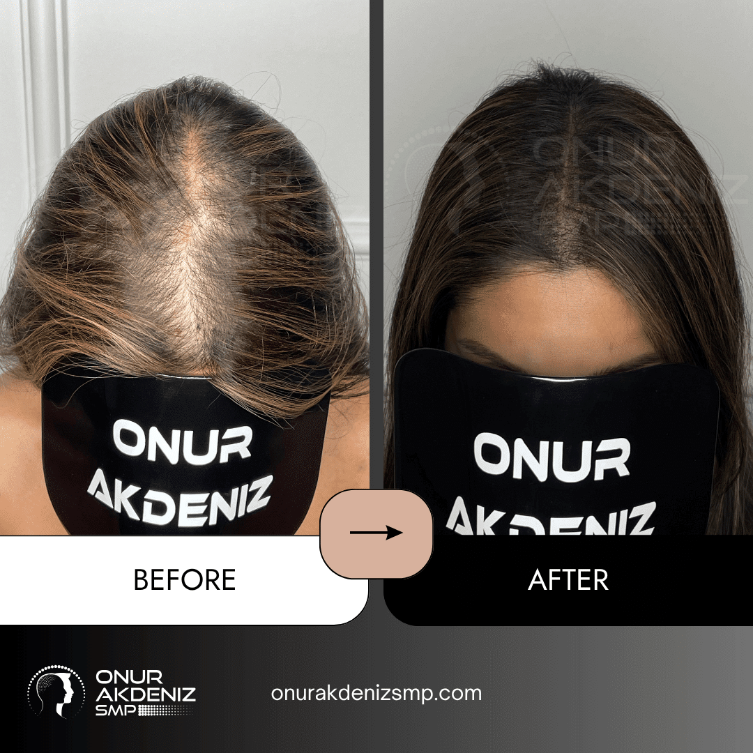 Onur Akdeniz SMP 192 Before and After Hair Densification for Women Onur Akdeniz SMP Istanbul Turkey 13