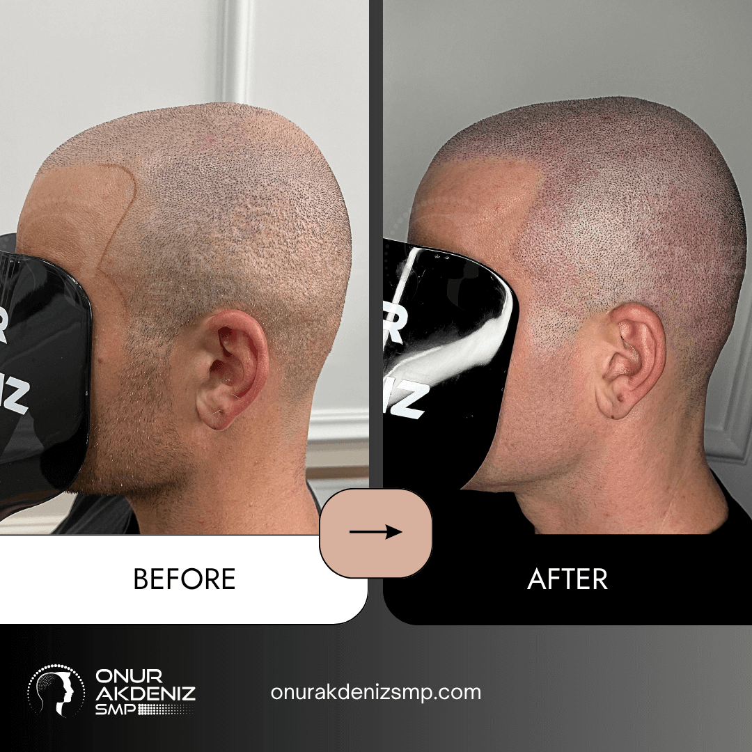 Onur Akdeniz SMP 99 Before and After Scalp Micropigmentation for a Shaved Look Onur Akdeniz SMP Istanbul Turkey 88