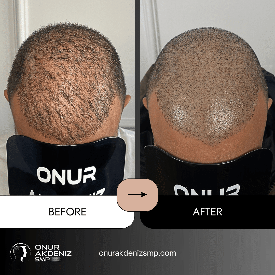 Onur Akdeniz SMP 102 Before and After Scalp Micropigmentation for a Shaved Look Onur Akdeniz SMP Istanbul Turkey 91
