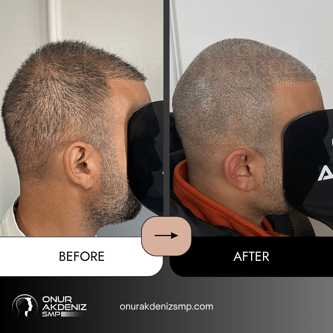 Onur Akdeniz SMP 105 Before and After Scalp Micropigmentation for a Shaved Look Onur Akdeniz SMP Istanbul Turkey 94