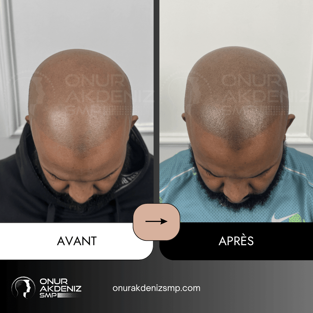 Avant Apres Micropigmentation Capillaire pour un Look Rase Africain Onur Akdeniz SMP Istanbul Turquie 17
