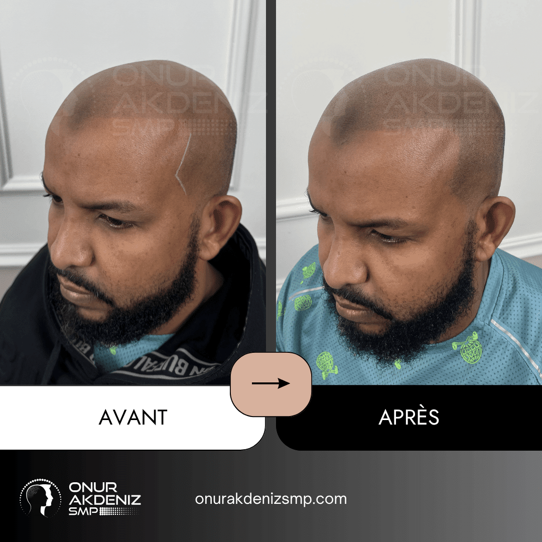Avant Apres Micropigmentation Capillaire pour un Look Rase Africain Onur Akdeniz SMP Istanbul Turquie 18