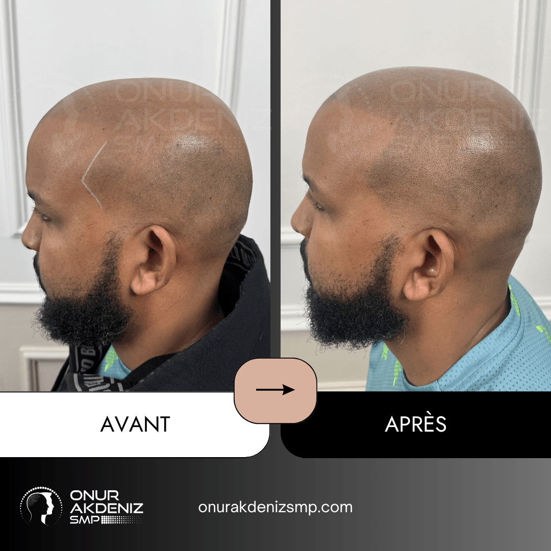 Avant Apres Micropigmentation Capillaire pour un Look Rase Africain Onur Akdeniz SMP Istanbul Turquie 19