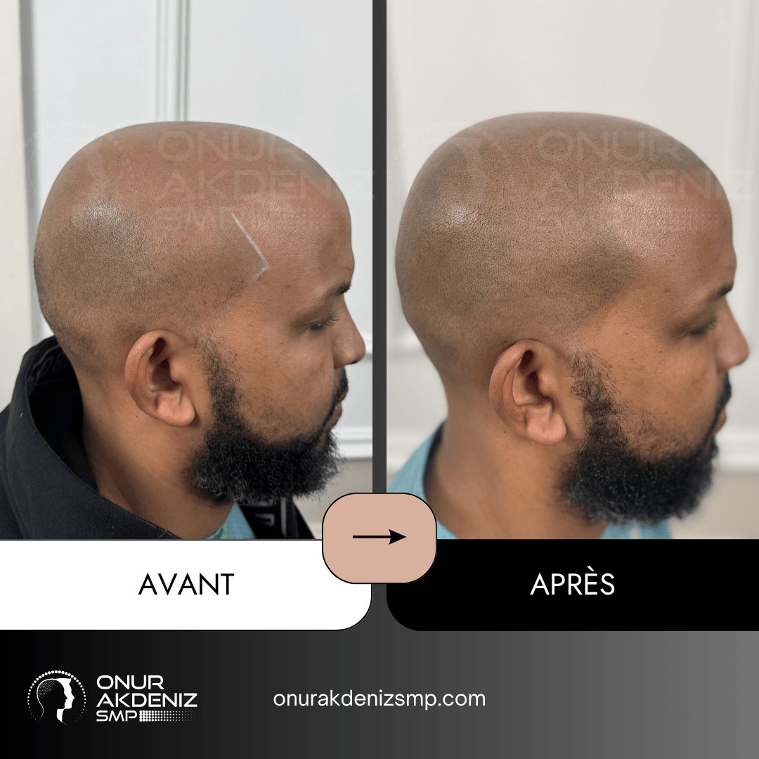 Avant Apres Micropigmentation Capillaire pour un Look Rase Africain Onur Akdeniz SMP Istanbul Turquie 20