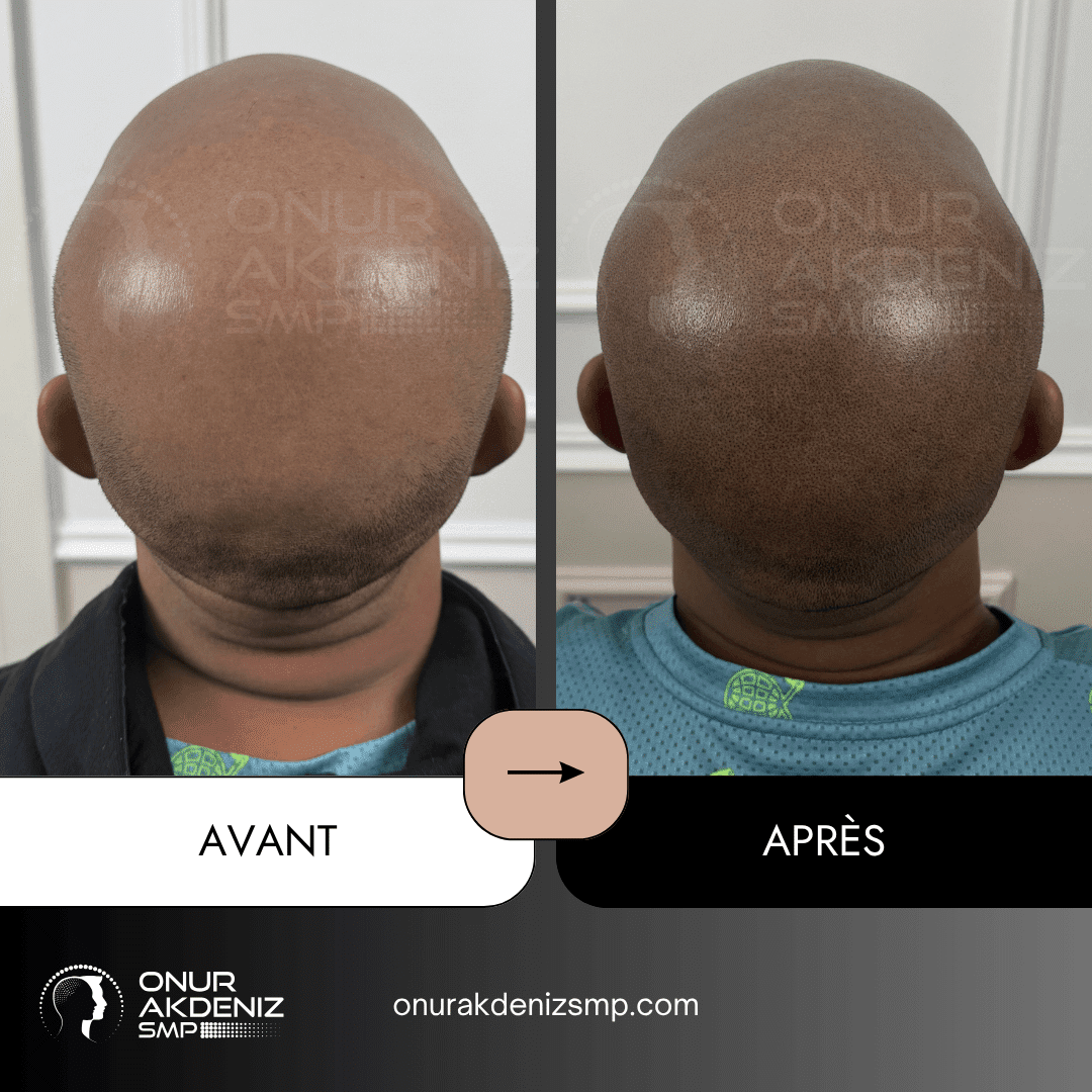Avant Apres Micropigmentation Capillaire pour un Look Rase Africain Onur Akdeniz SMP Istanbul Turquie 21