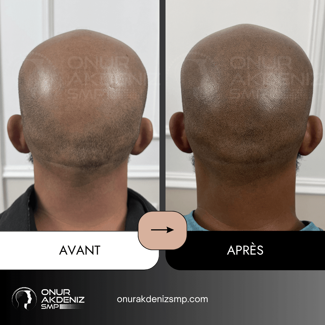 Avant Apres Micropigmentation Capillaire pour un Look Rase Africain Onur Akdeniz SMP Istanbul Turquie 22