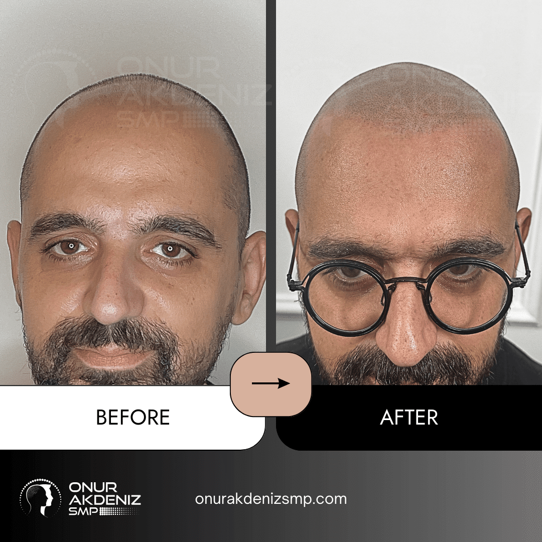 Before and After Scalp Micropigmentation for a Shaved Look Onur Akdeniz SMP Istanbul Turkey 133