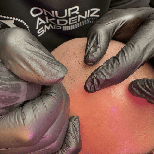 Types de coups daiguille en micropigmentation capillaire 2