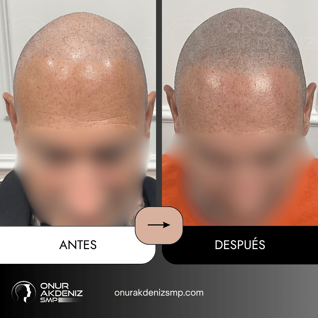 Antes y despues de la micropigmentacion del cuero cabelludo para un aspecto rapado – Onur Akdeniz Estambul Turquia 110