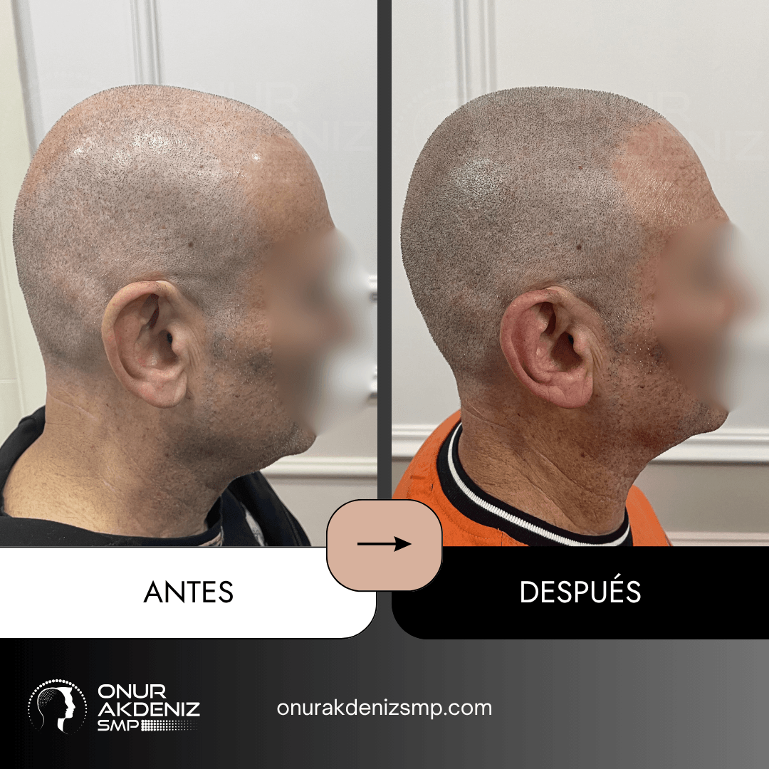 Antes y despues de la micropigmentacion del cuero cabelludo para un aspecto rapado – Onur Akdeniz Estambul Turquia 115
