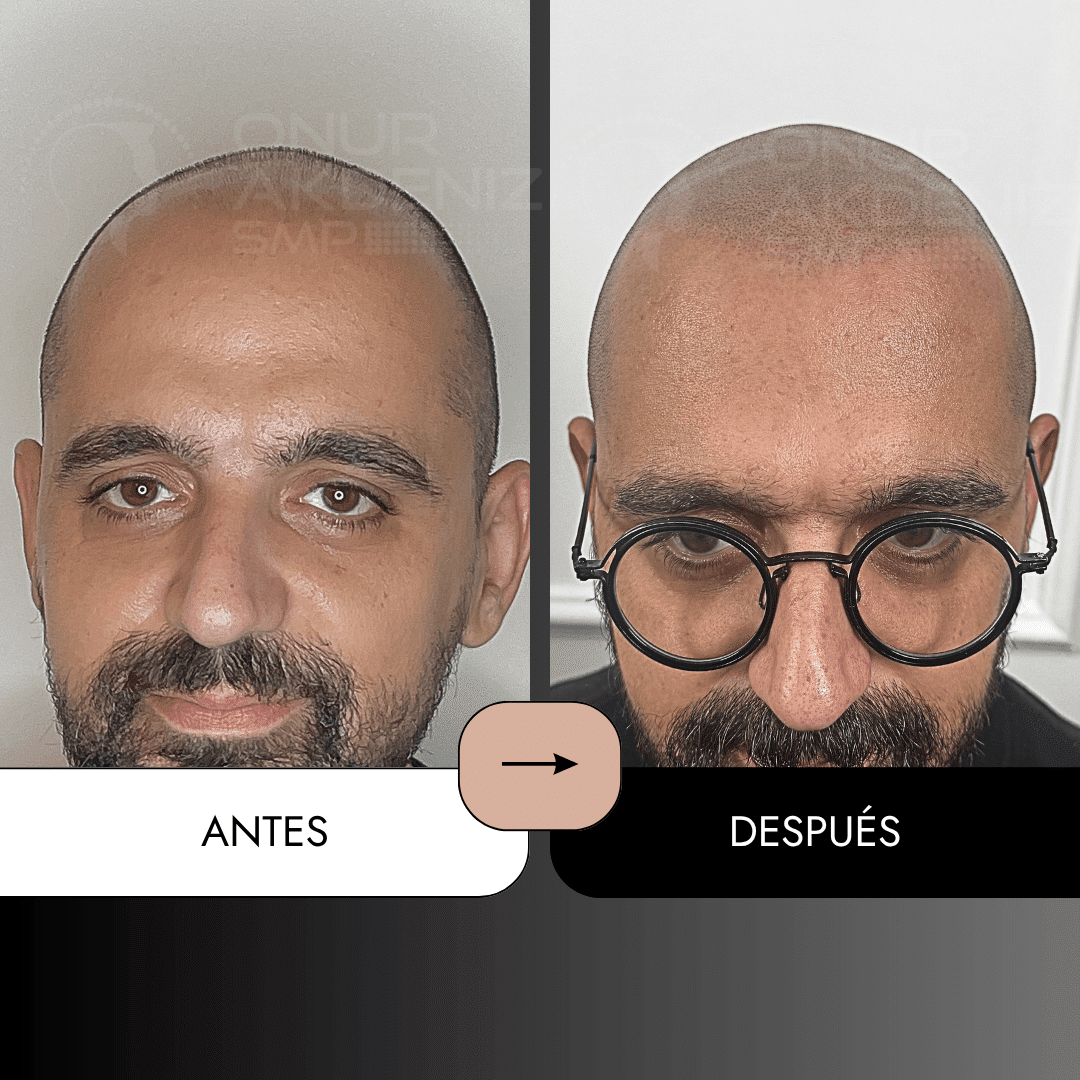 Antes y despues de la micropigmentacion del cuero cabelludo para un aspecto rapado – Onur Akdeniz Estambul Turquia 133