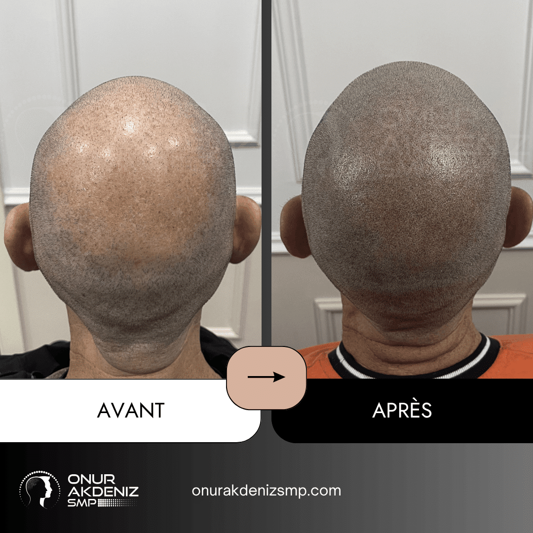 Avant et apres la micropigmentation du cuir chevelu pour un look rase – Onur Akdeniz Istanbul Turquie 117