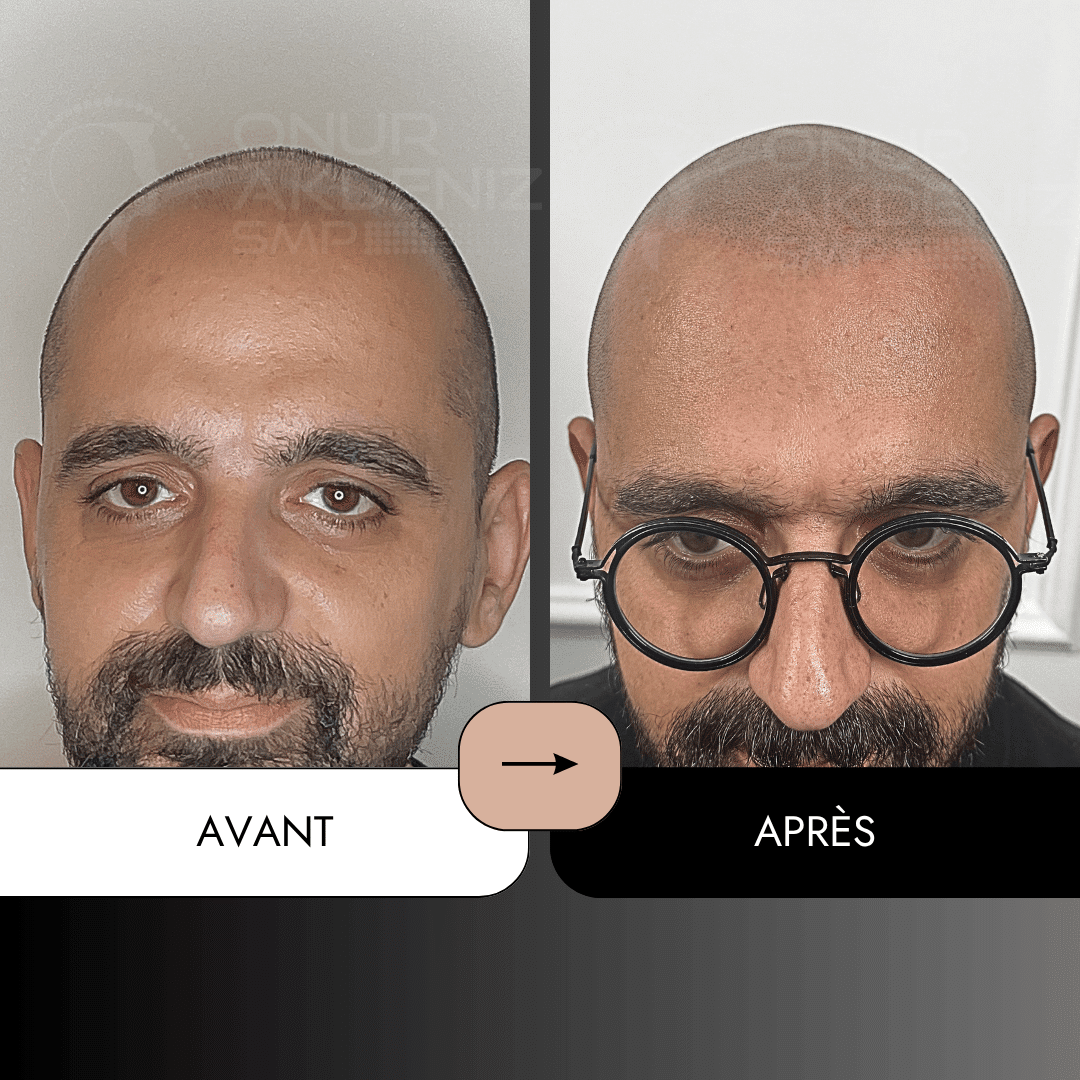 Avant et apres la micropigmentation du cuir chevelu pour un look rase – Onur Akdeniz Istanbul Turquie 133