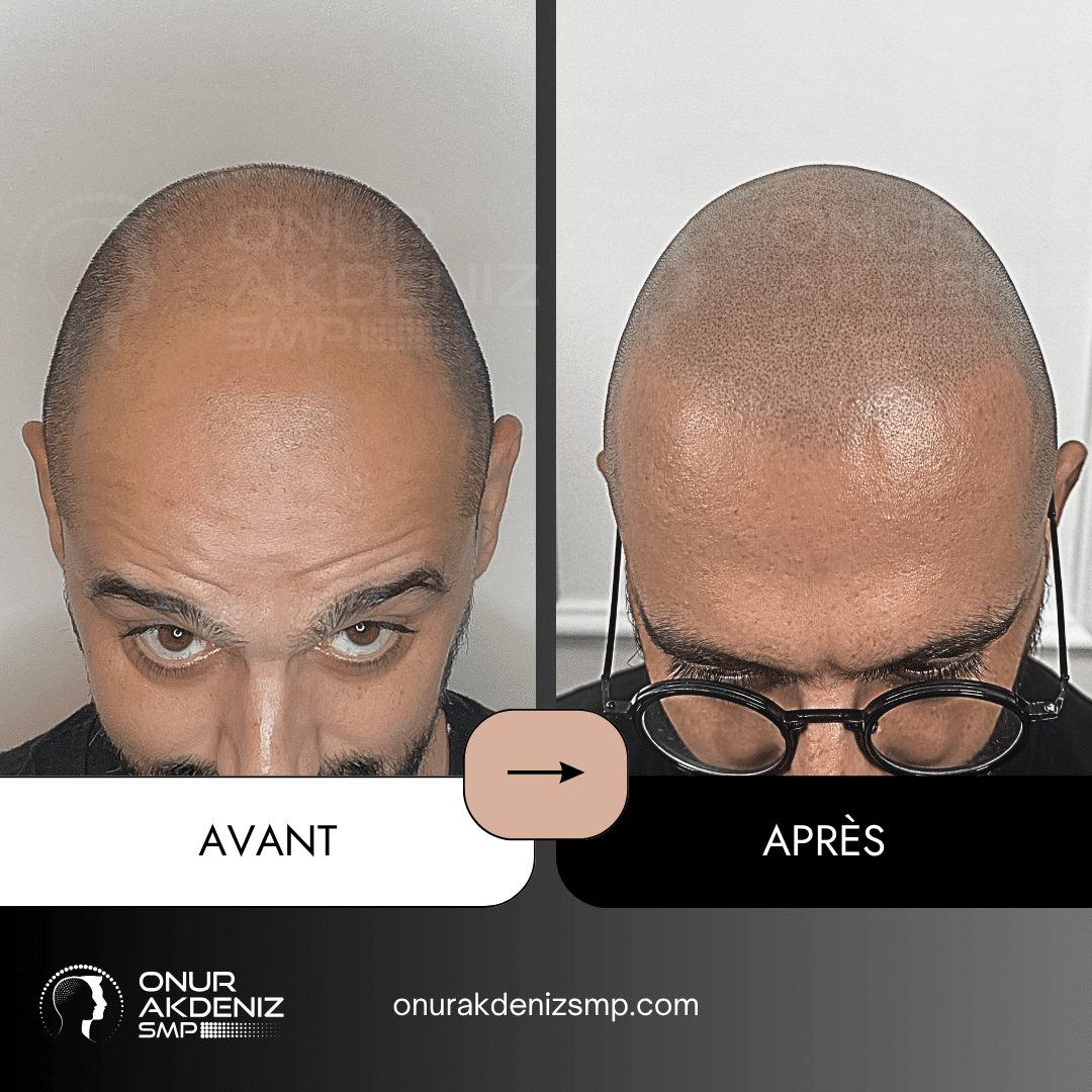 Avant et apres la micropigmentation du cuir chevelu pour un look rase – Onur Akdeniz Istanbul Turquie 134