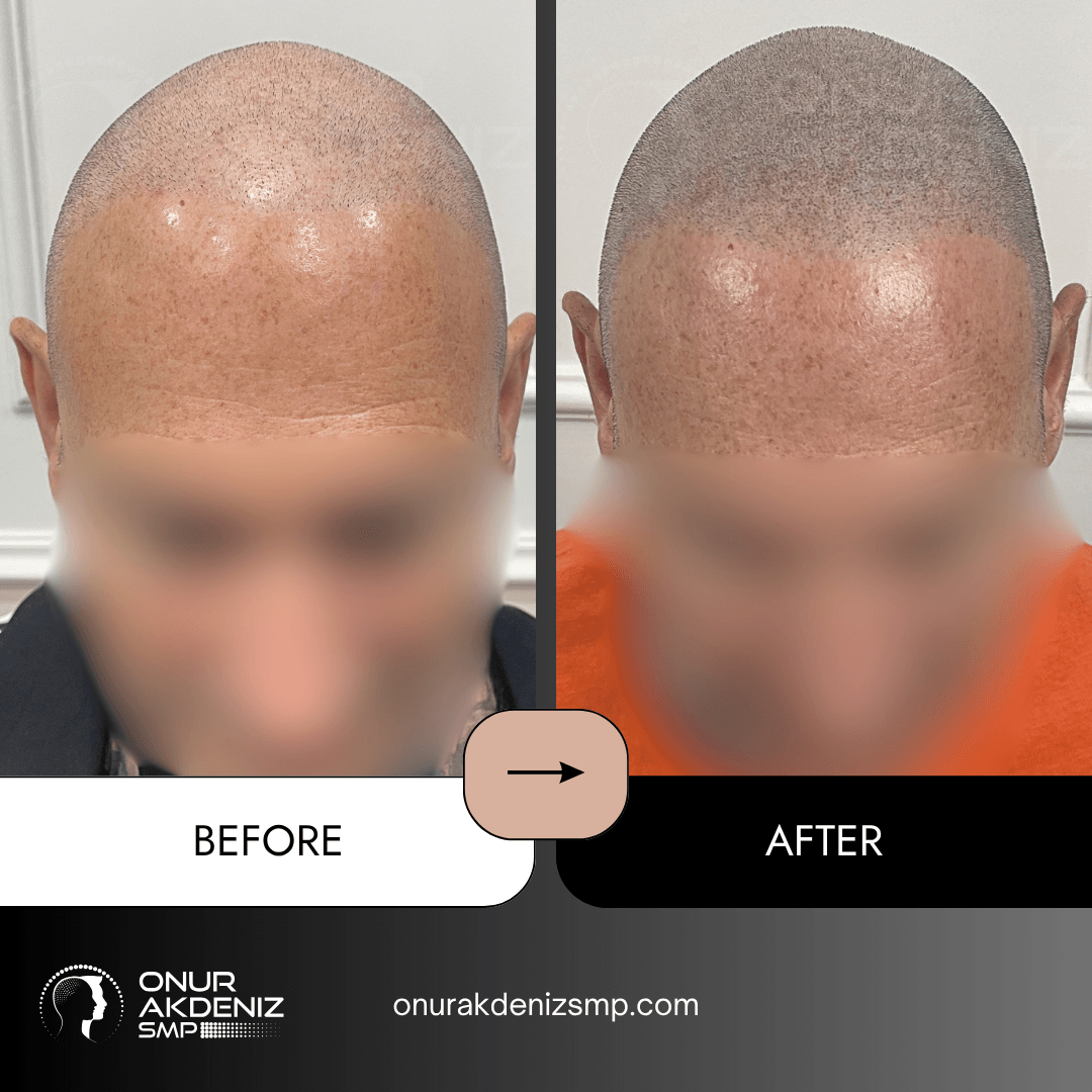 Before and After Scalp Micropigmentation for a Shaved Look Onur Akdeniz SMP Istanbul Turkey 110