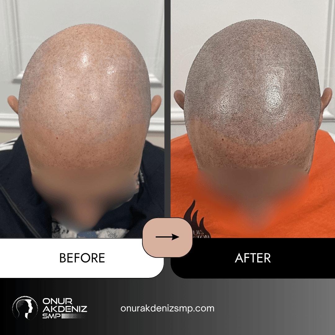 Before and After Scalp Micropigmentation for a Shaved Look Onur Akdeniz SMP Istanbul Turkey 112