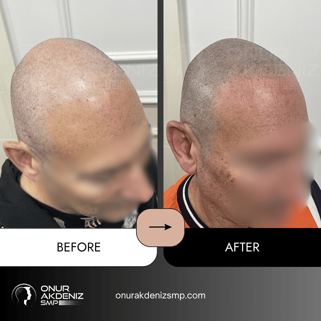 Before and After Scalp Micropigmentation for a Shaved Look Onur Akdeniz SMP Istanbul Turkey 113
