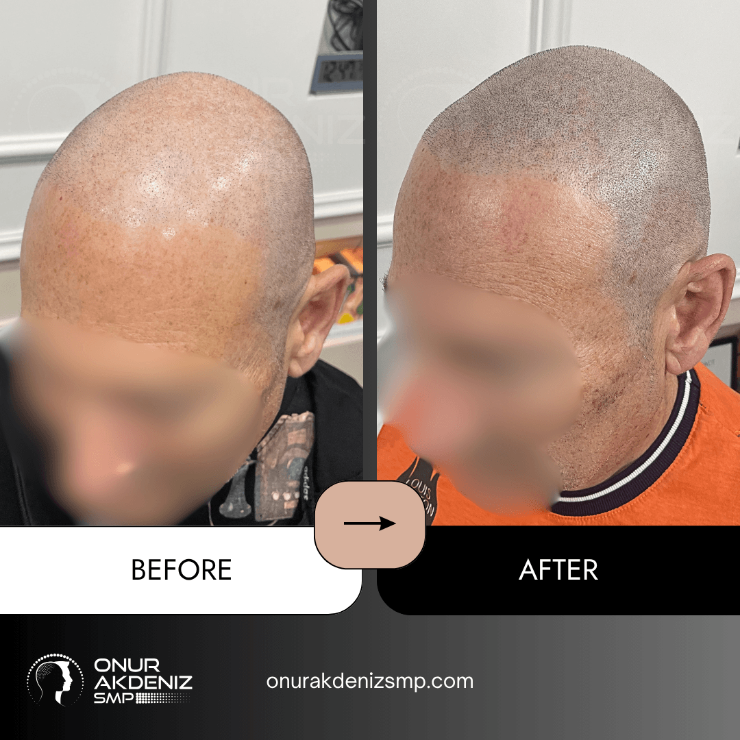 Before and After Scalp Micropigmentation for a Shaved Look Onur Akdeniz SMP Istanbul Turkey 114