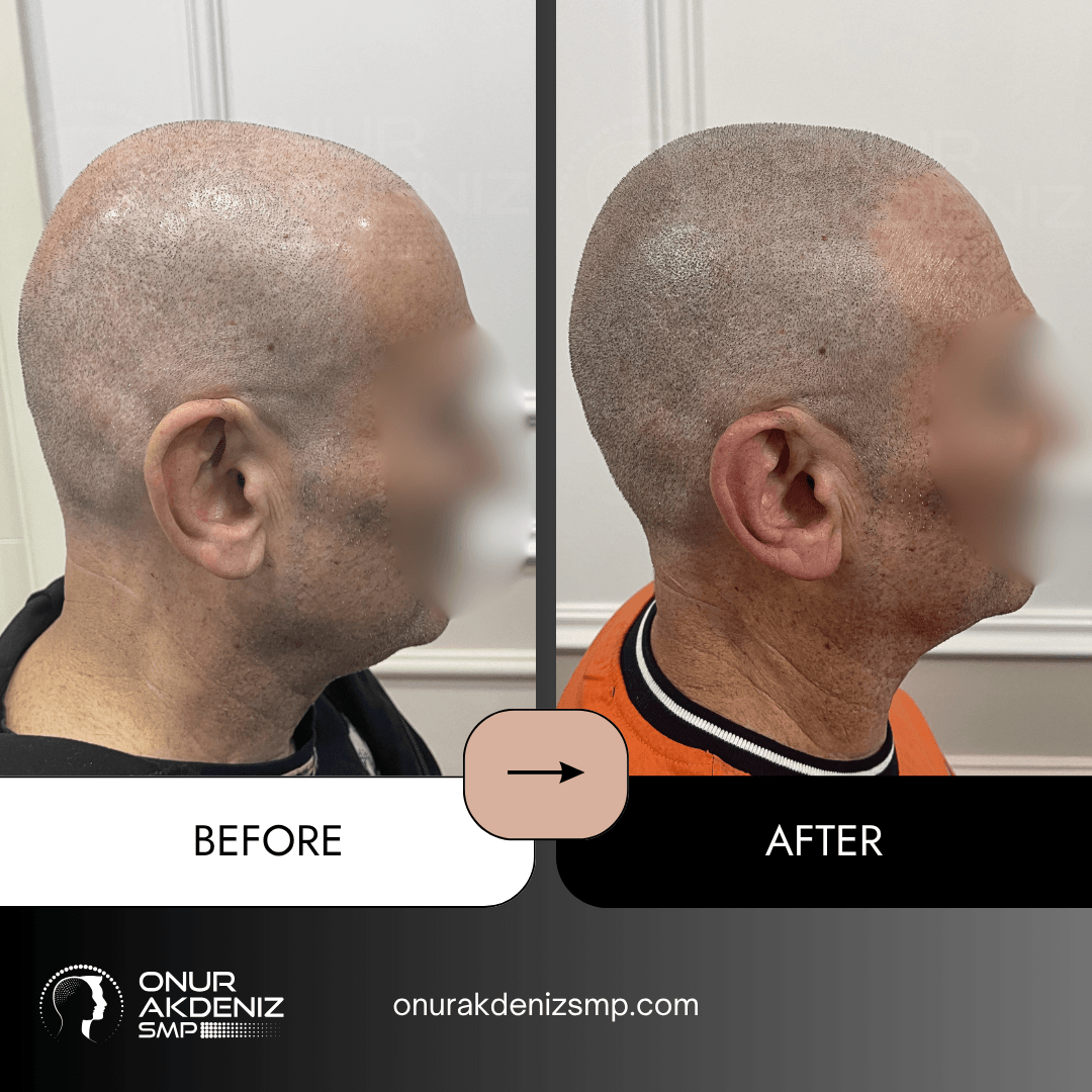 Before and After Scalp Micropigmentation for a Shaved Look Onur Akdeniz SMP Istanbul Turkey 115
