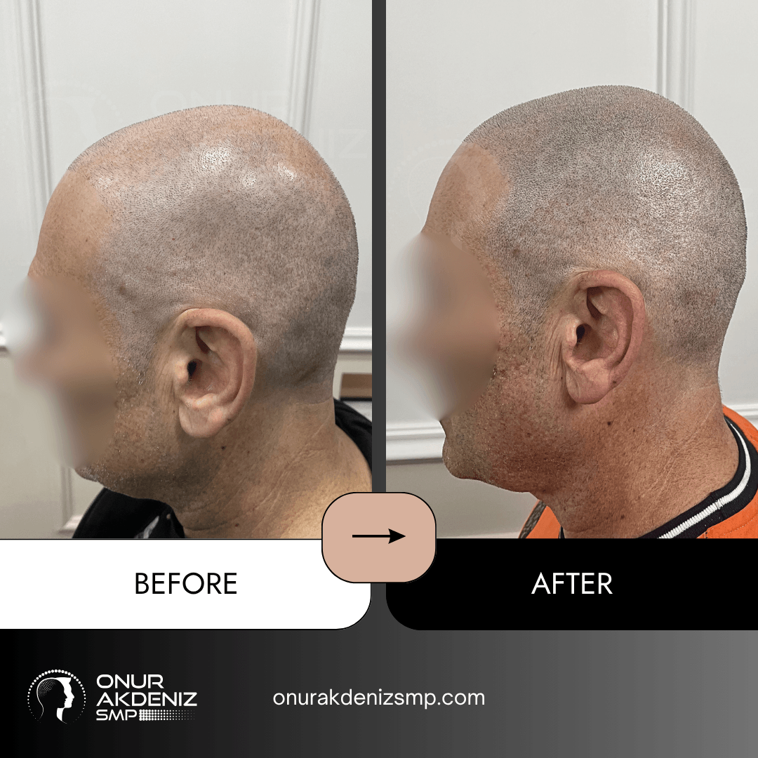 Before and After Scalp Micropigmentation for a Shaved Look Onur Akdeniz SMP Istanbul Turkey 116