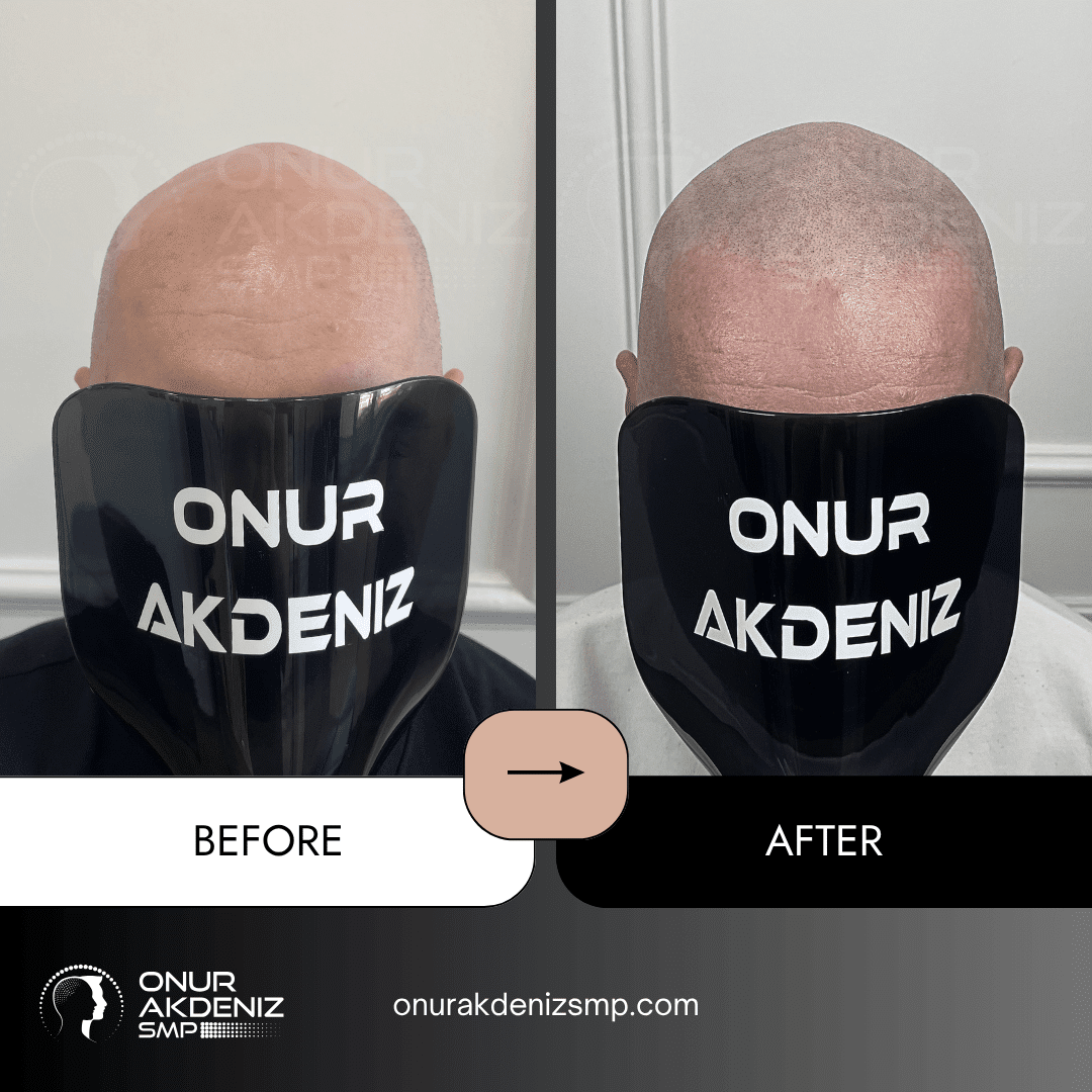 Before and After Scalp Micropigmentation for a Shaved Look Onur Akdeniz SMP Istanbul Turkey 118