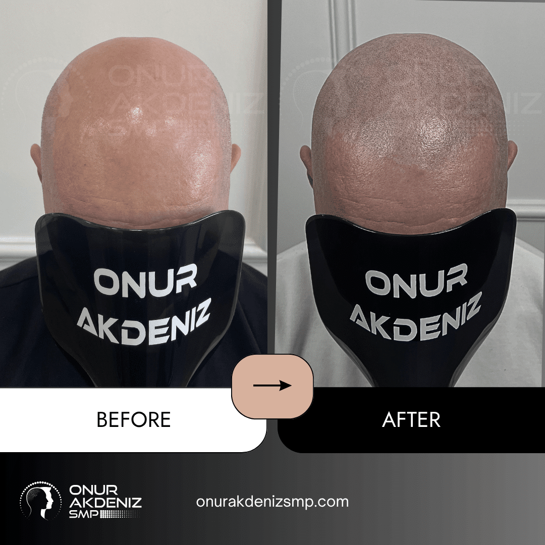 Before and After Scalp Micropigmentation for a Shaved Look Onur Akdeniz SMP Istanbul Turkey 119