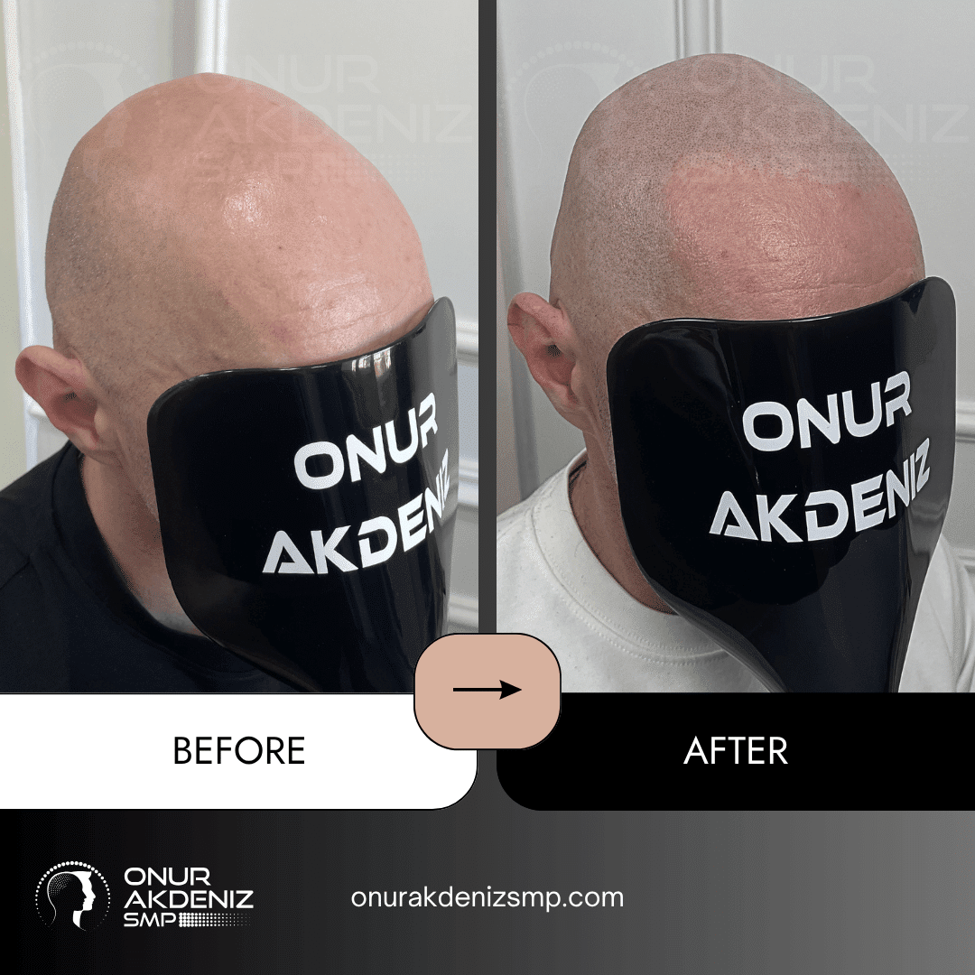 Before and After Scalp Micropigmentation for a Shaved Look Onur Akdeniz SMP Istanbul Turkey 120