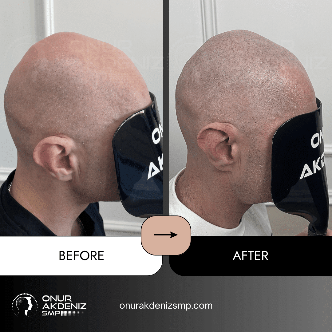 Before and After Scalp Micropigmentation for a Shaved Look Onur Akdeniz SMP Istanbul Turkey 122