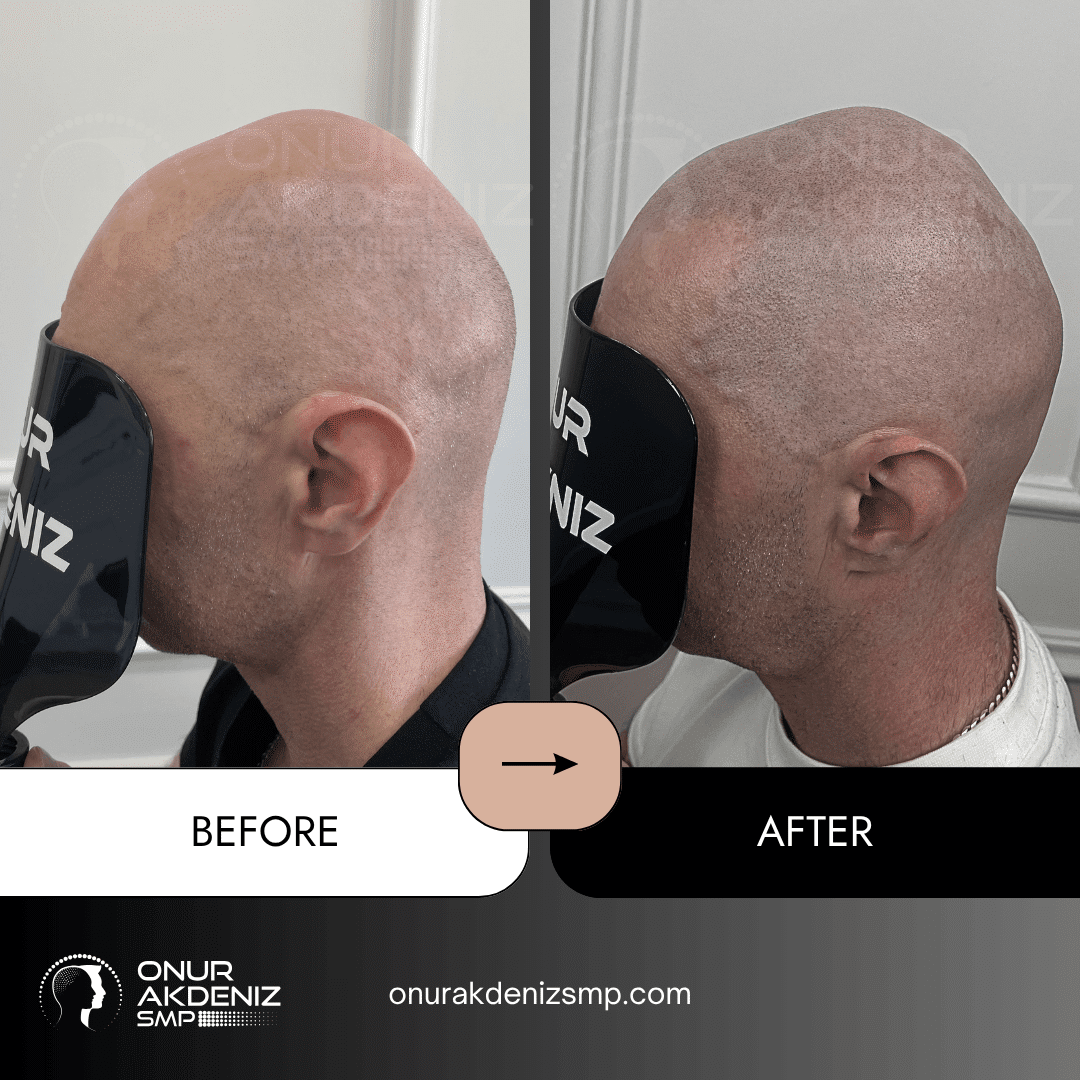 Before and After Scalp Micropigmentation for a Shaved Look Onur Akdeniz SMP Istanbul Turkey 123