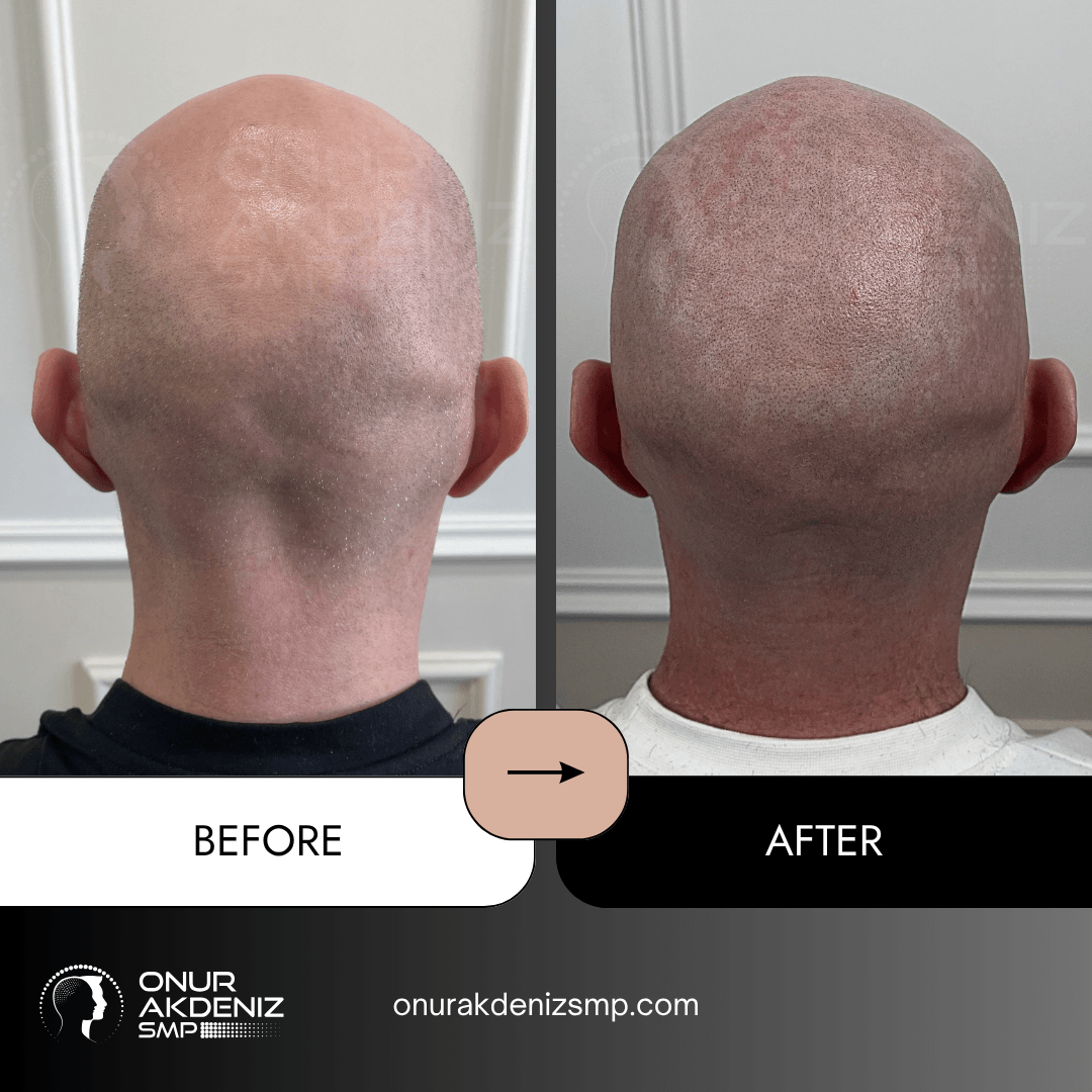 Before and After Scalp Micropigmentation for a Shaved Look Onur Akdeniz SMP Istanbul Turkey 124
