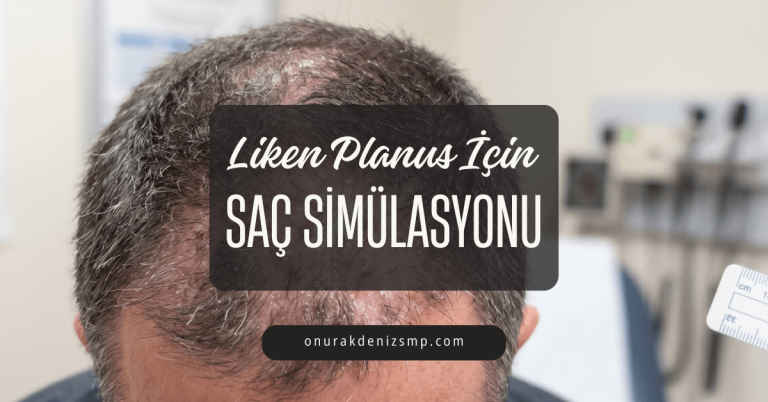 Liken Planus İçin Saç Simülasyonu