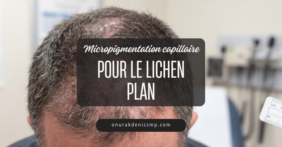 Micropigmentation capillaire pour le Lichen Plan