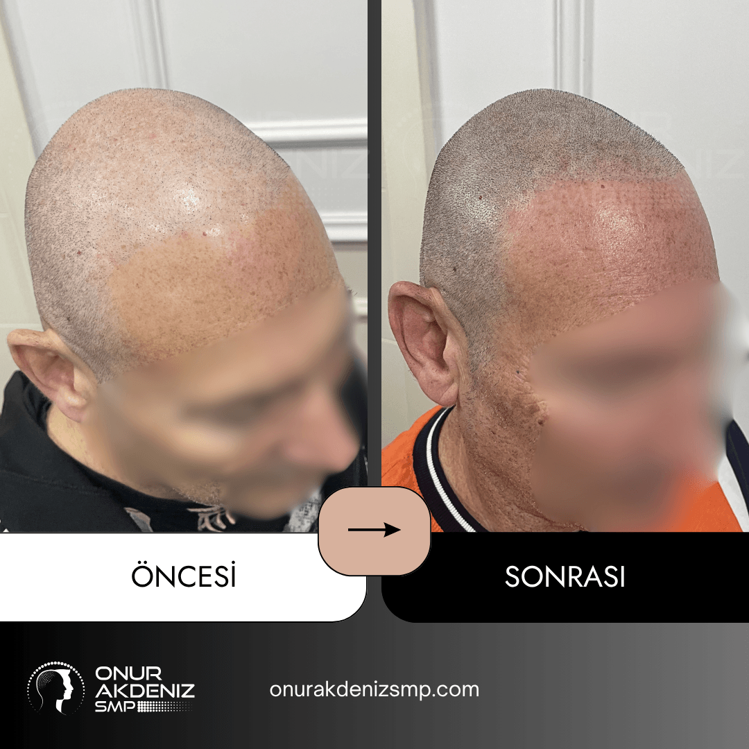 Onur Akdeniz SMP tarafindan tirasli sac gorunumu icin sac mikropigmentasyonu oncesi ve sonrasi 112
