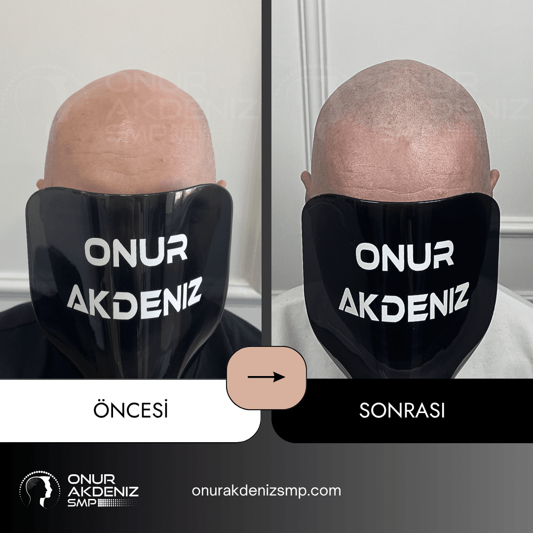Onur Akdeniz SMP tarafindan tirasli sac gorunumu icin sac mikropigmentasyonu oncesi ve sonrasi 117