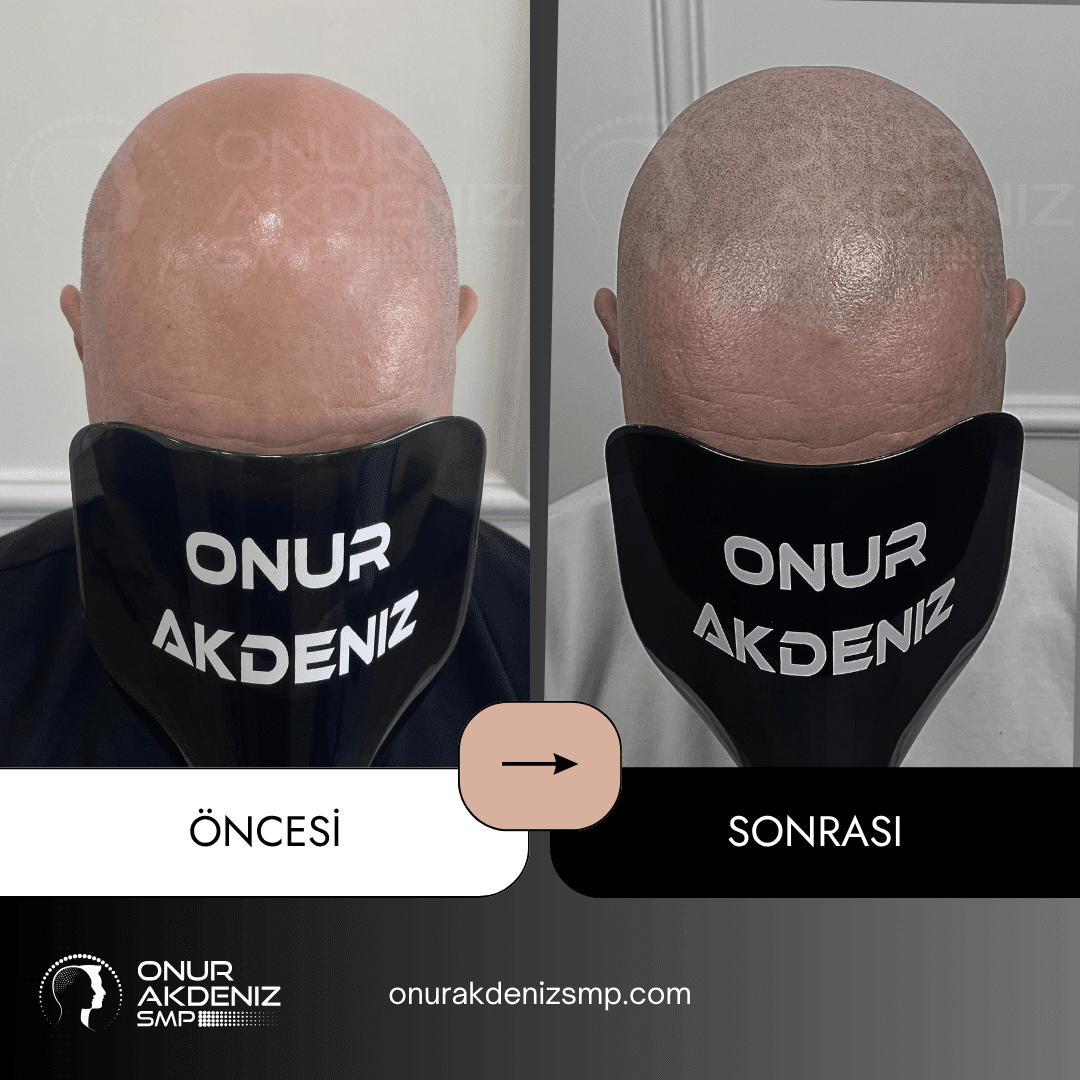 Onur Akdeniz SMP tarafindan tirasli sac gorunumu icin sac mikropigmentasyonu oncesi ve sonrasi 118