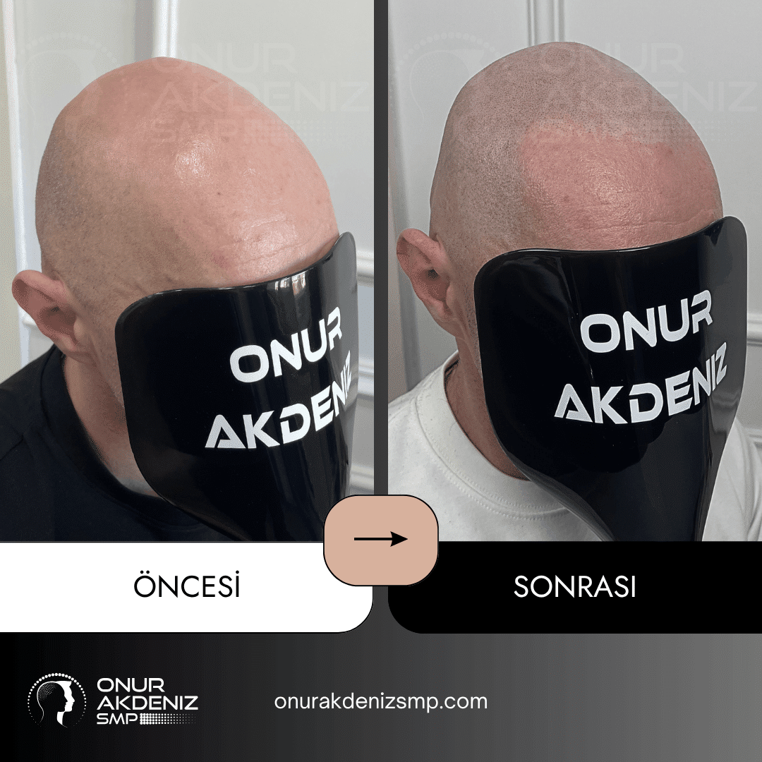 Onur Akdeniz SMP tarafindan tirasli sac gorunumu icin sac mikropigmentasyonu oncesi ve sonrasi 119