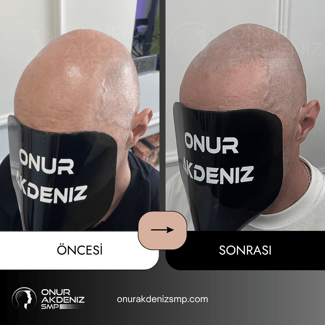 Onur Akdeniz SMP tarafindan tirasli sac gorunumu icin sac mikropigmentasyonu oncesi ve sonrasi 120